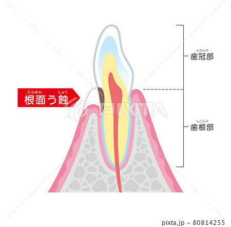 根面う蝕　イラスト図解 80814255