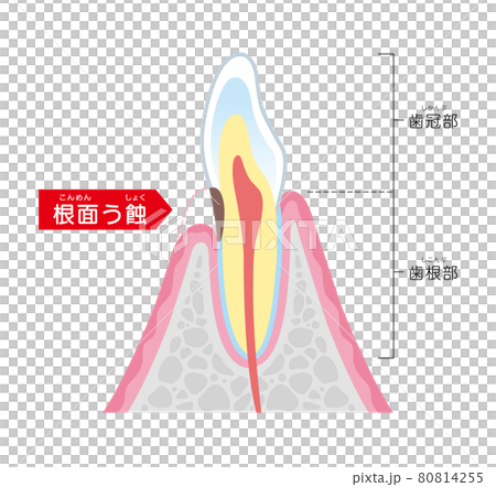 Root caries illustration illustration 80814255