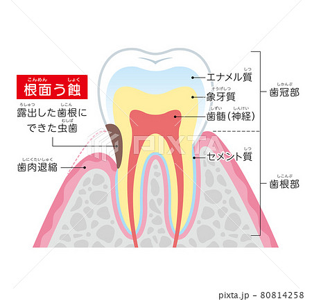 根面う蝕 イラスト図解 根面う蝕 イラスト図解 80814258
