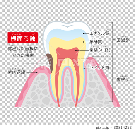 根面う蝕 イラスト図解 根面う蝕 イラスト図解 80814258