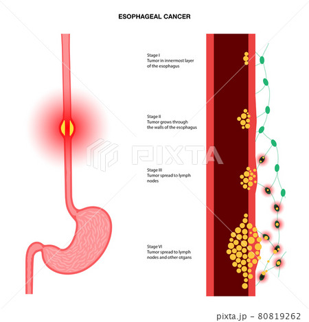esophageal cancer stages esophageal cancer stages 80819262