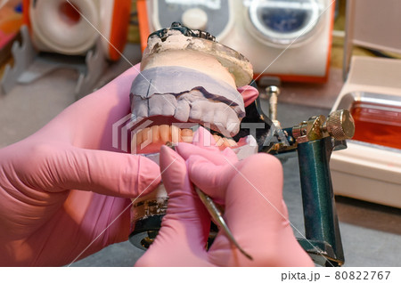 Modeling the installation of a denture with wax. Modeling the installation of a denture with wax. 80822767