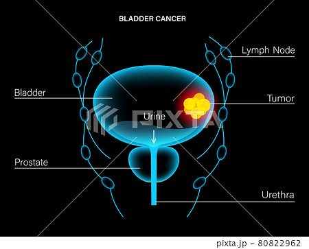 Bladder cancer stages 80822962