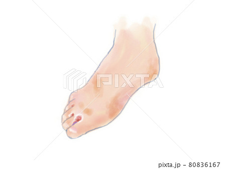 水虫の足の水彩イラスト 水虫の足の水彩イラスト 80836167