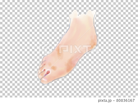 水虫の足の水彩イラスト 水虫の足の水彩イラスト 80836167