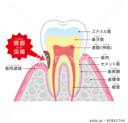 根面虫歯 イラスト図解 根面虫歯 イラスト図解 80842744