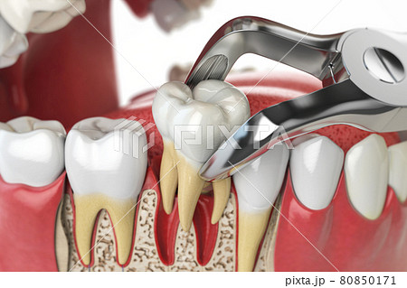 Tooth extraction by dental forceps on model of human jaw. 3d illustration 80850171