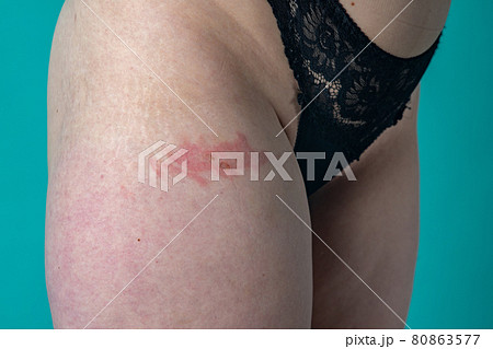 female stomach and legs covered in stretch marks with cellulite 80863577