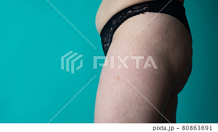 female stomach and legs covered in stretch marks with cellulite 80863691