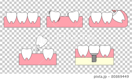 Illustration of gingival teeth. Healthy teeth, wobbling teeth, missing teeth, implants. 80869449