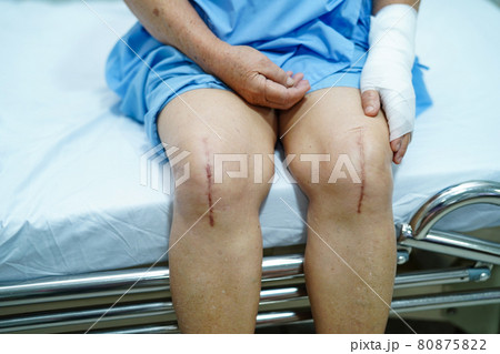 Asian senior or elderly old lady woman patient show her scars surgical total knee joint replacement Suture wound surgery arthroplasty on bed in nursing hospital ward : healthy strong medical concept.. 80875822