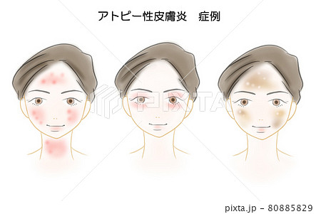アトピー性皮膚炎 優しいタッチのイラスト アトピー性皮膚炎 優しいタッチのイラスト 80885829
