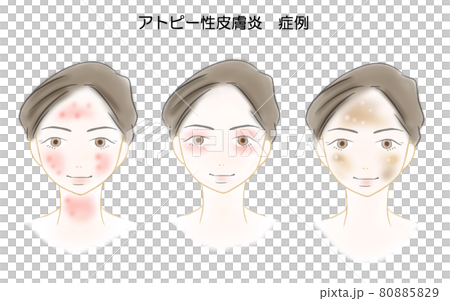 アトピー性皮膚炎 優しいタッチのイラスト アトピー性皮膚炎 優しいタッチのイラスト 80885829