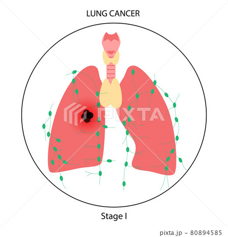 Lungs cancer disease 80894585