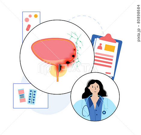 Bladder cancer stages Bladder cancer stages 80898684