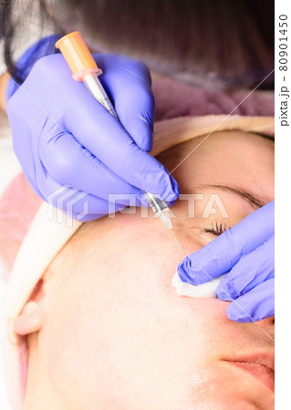 Miliums on the face, removal of hardened and mature milia by a beautician. 80901450