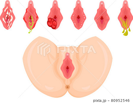 女性外性器 病気 単体 イラストのイラスト素材