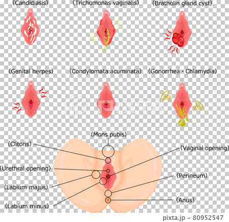 Female external genital illness English illustration 80952547