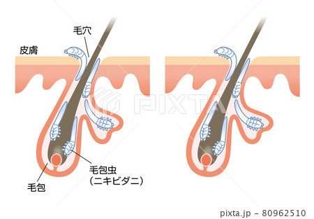 毛包虫　ニキビダニ　皮膚　毛穴　毛根　イラスト 80962510