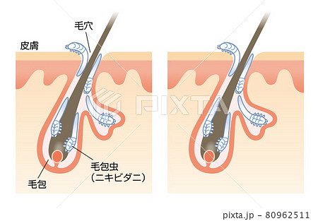 毛包虫 ニキビダニ 皮膚 毛穴 毛根 イラスト 毛包虫 ニキビダニ 皮膚 毛穴 毛根 イラスト 80962511