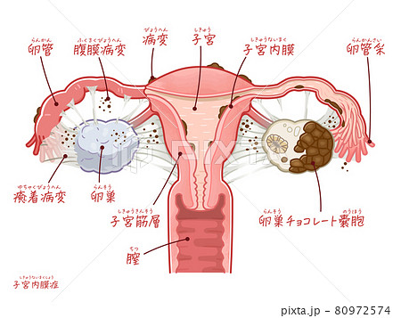子宮内膜症の子宮、卵巣、卵管のイラスト（テキスト付き） 80972574