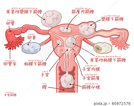 子宮筋腫の子宮 卵巣 卵管のイラスト テキスト付き のイラスト素材