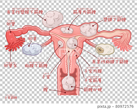Illustration of uterine, ovary, and fallopian tubes of uterine fibroids (with text) Illustration of uterine, ovary, and fallopian tubes of uterine fibroids (with text) 80972576