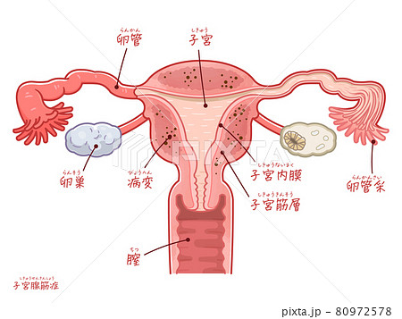 子宮腺筋症の子宮、卵巣、卵管のイラスト（テキスト付き） 80972578
