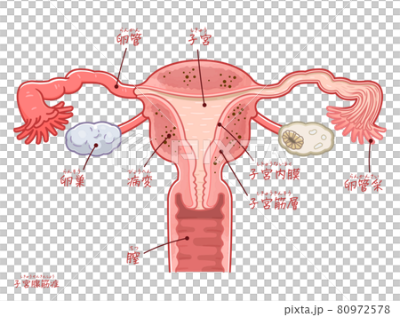 子宮腺筋症の子宮、卵巣、卵管のイラスト（テキスト付き） 80972578