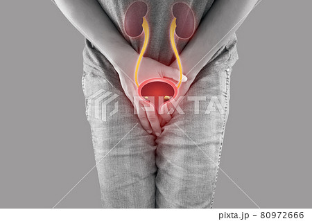 Bladder stones 80972666