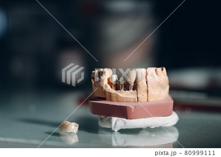 Dental layout of the human jaw with teeth and implants. Dental layout of the human jaw with teeth and implants. 80999111