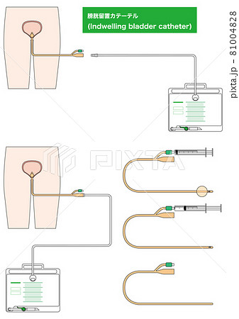 医療 膀胱留置カテーテルの部品 縦 のイラスト素材