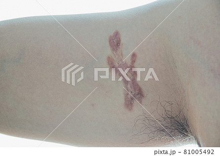 水痘に罹患後24年、できた水疱をつぶさずに痕が大きくなってしまった男性の腕の写真 水痘に罹患後24年、できた水疱をつぶさずに痕が大きくなってしまった男性の腕の写真 81005492