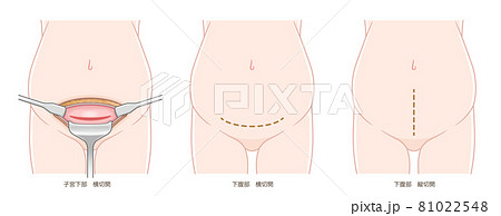 妊娠している女性の体 帝王切開の切り方のイラストのイラスト素材