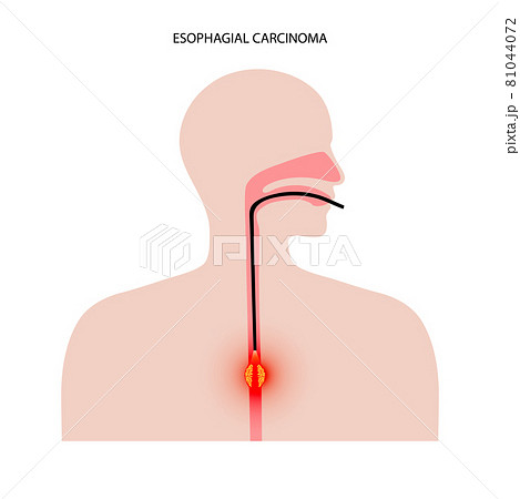 Esophagus endoscopy procedure 81044072