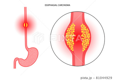 esophageal cancer concept esophageal cancer concept 81044929