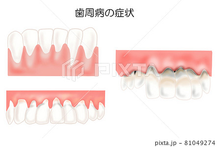 歯周病の症状3つのイラスト 81049274