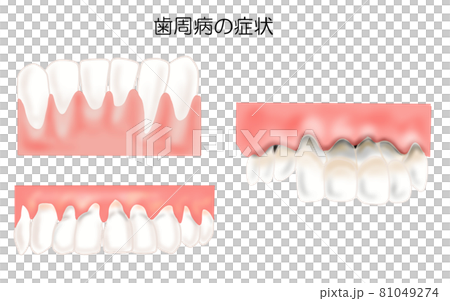 歯周病の症状3つのイラスト 81049274