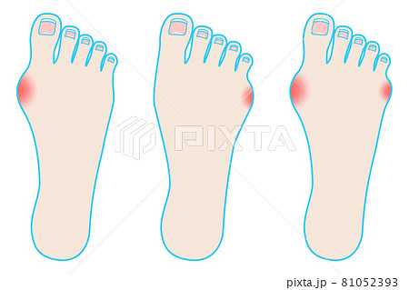 足のトラブル 外反母趾と内反小趾 のイラスト素材