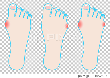 足のトラブル（外反母趾と内反小趾） 81052393
