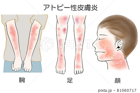 アトピー性皮膚炎 やさしいタッチのイラストのイラスト素材