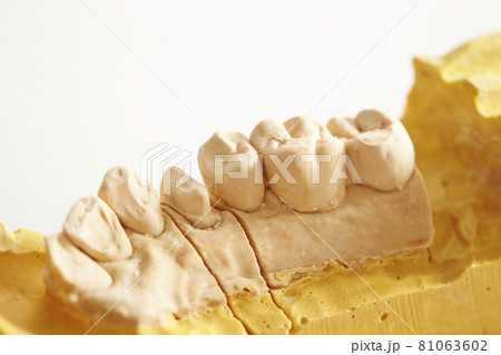 石こう歯型模型　歯科イメージ 81063602