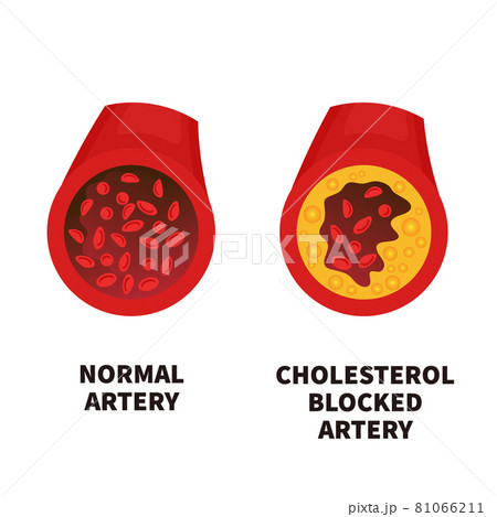 Normal and narrowed artery cross section illustration 81066211