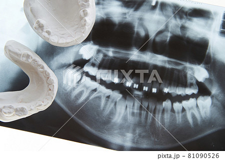 レントゲン写真と石こう歯型　歯科イメージ 81090526