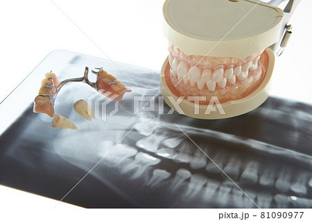 部分入れ歯ブリッジとレントゲン写真 歯科イメージ 部分入れ歯ブリッジとレントゲン写真 歯科イメージ 81090977