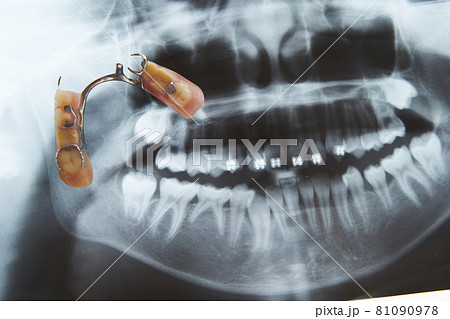 部分入れ歯ブリッジとレントゲン写真 歯科イメージ 部分入れ歯ブリッジとレントゲン写真 歯科イメージ 81090978