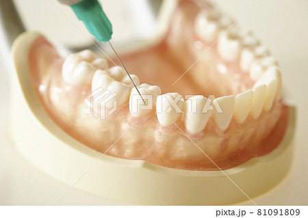 歯列模型と歯科麻酔　歯科イメージ 81091809