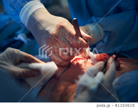 Surgeon removing extra fat and skin from patient abdomen. 81103619