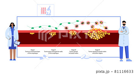 esophageal cancer stages esophageal cancer stages 81116633