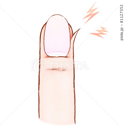 ささくれができた指と爪のイラストのイラスト素材